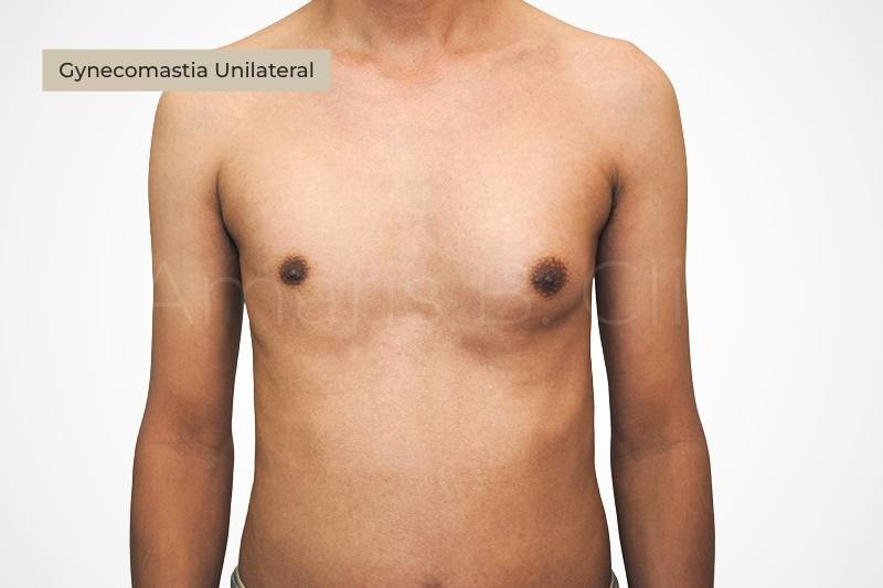 Unilateral one-sided gynecomastia versus bilateral male chest