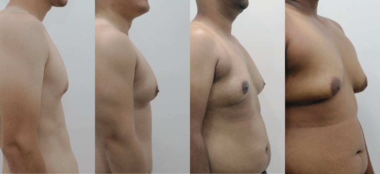 Gynecomastia Grades