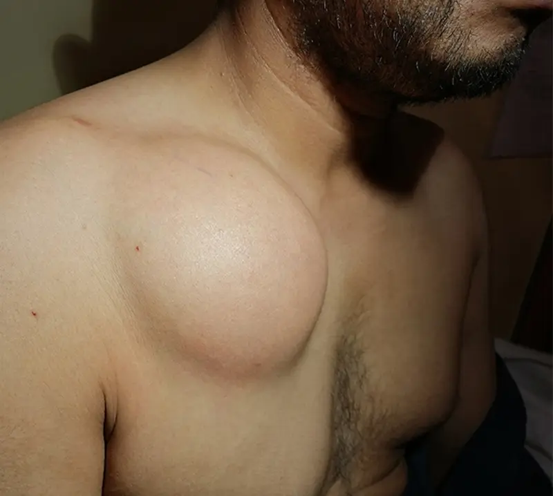 Lipoma