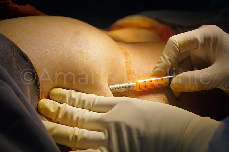 Is Breast Fat Grafting Safe? Risks, Side Effects, and Who It's Not For