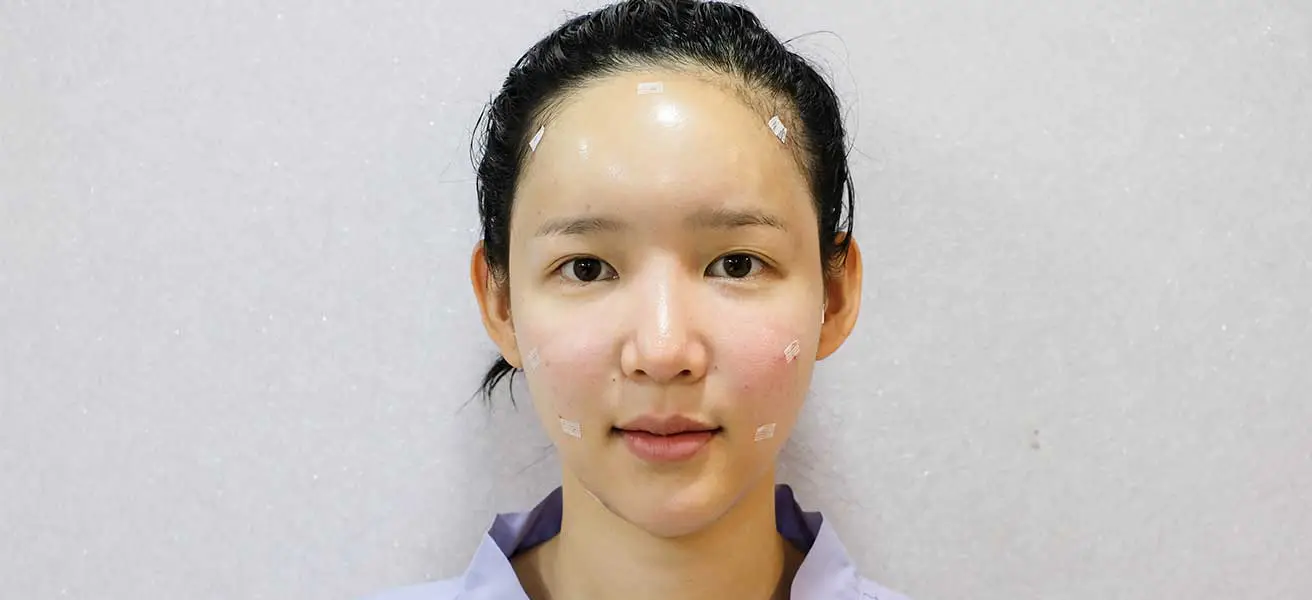 facial fat grafting recovery