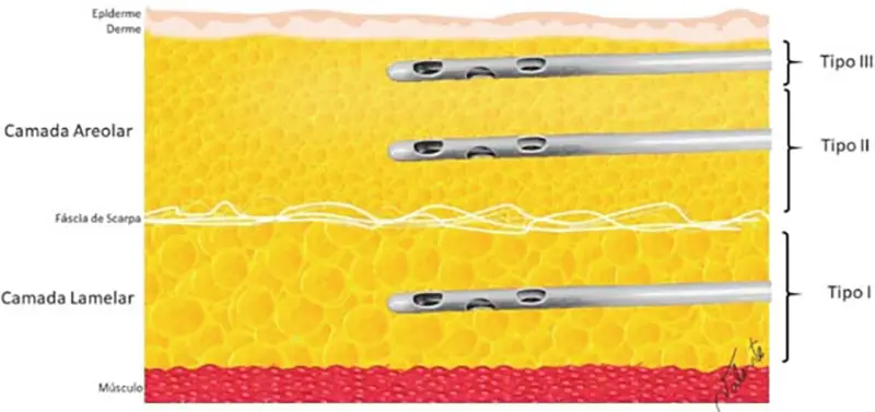 Diagram of liposuction types I, II and III showing fat layers relative to Scarpa’s fascia.