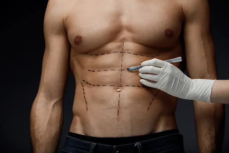 4D Vaser Hi-Def Lipo markings on male abs
