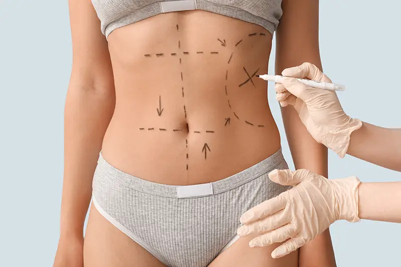 4D Vaser Hi-Def Lipo markings on female abs
