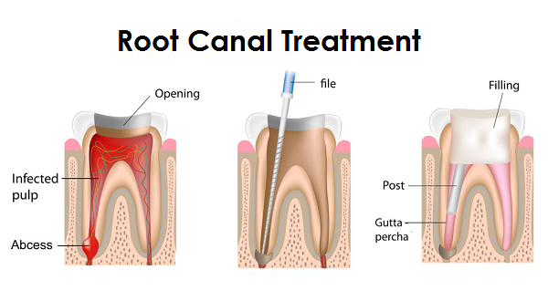 Root Canal Kalgoorlie