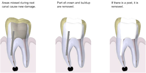 Root Canal Treatment Smile Dental