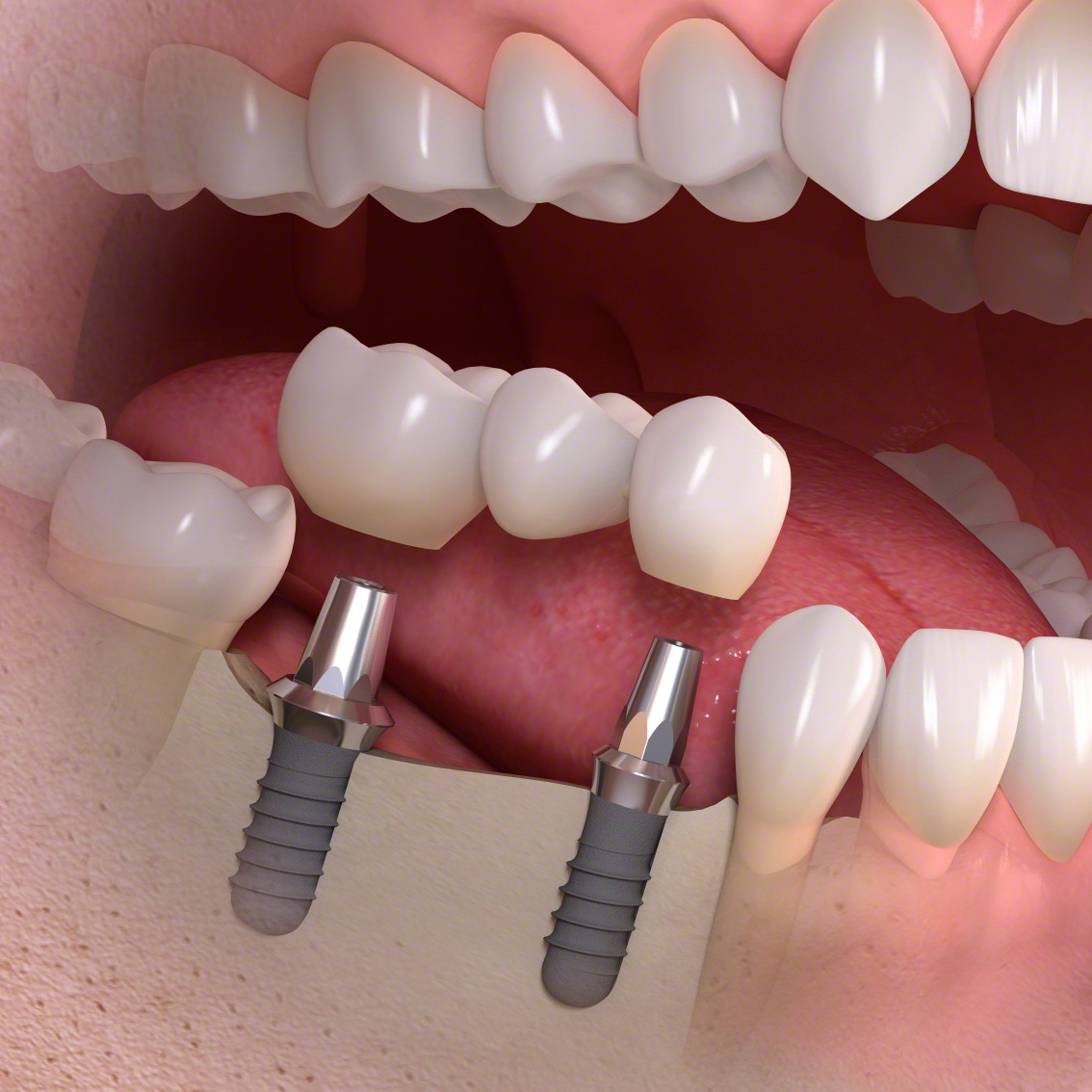 Dental implants placed to replace missing teeth at Smile Dental Clinic in Kalgoorlie