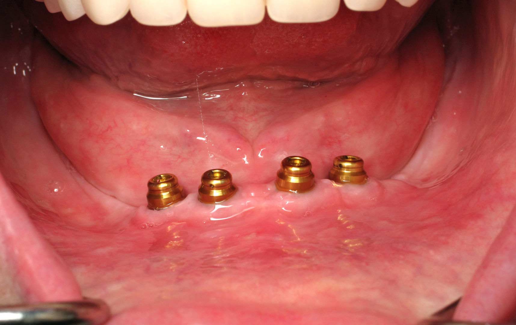 Implant supported over denture secured on dental implants at Smile Dental Clinic in Kalgoorlie