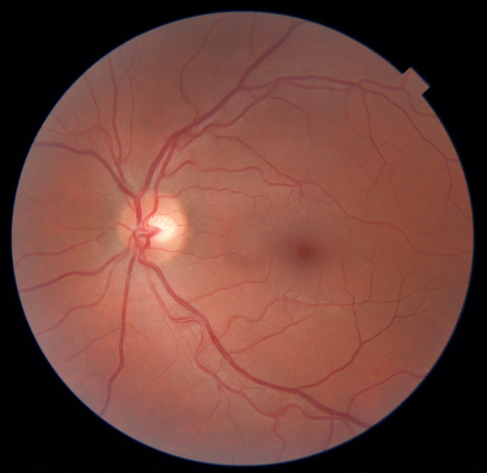 RetinaLyze - Case Profil Optik Varde Våd AMD