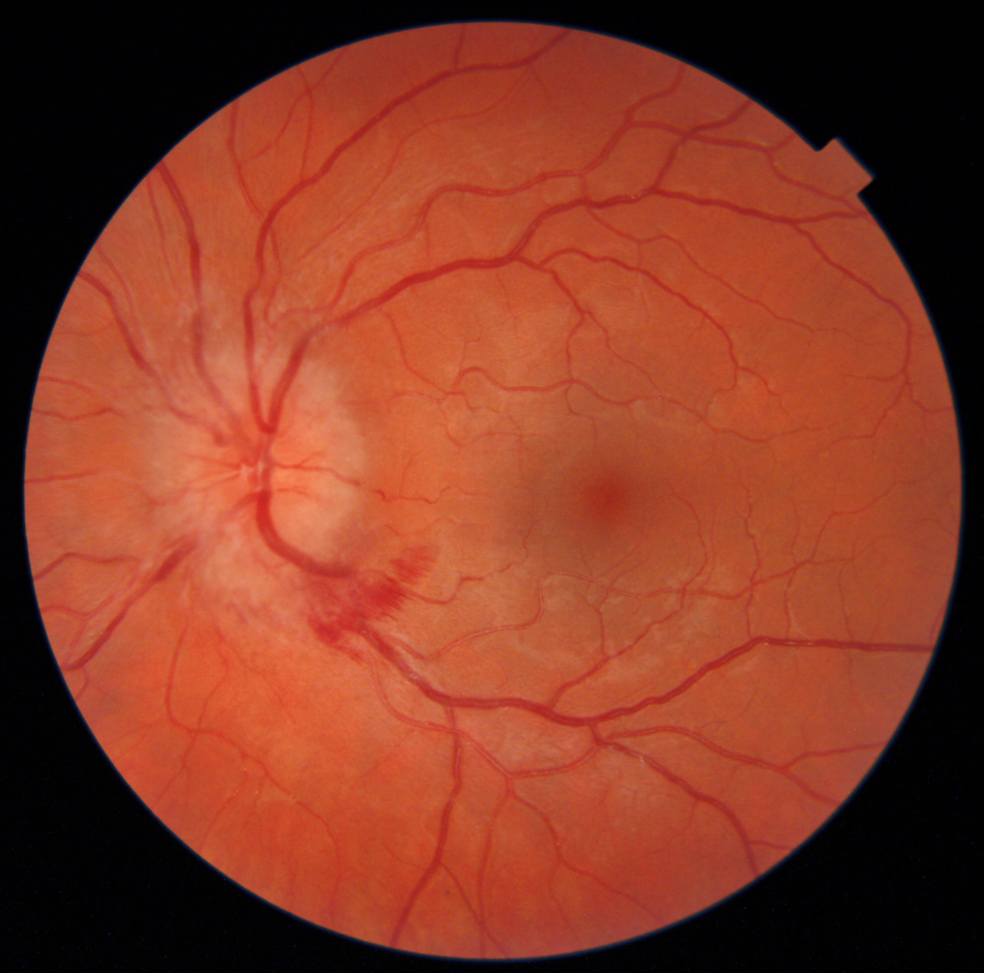 RetinaLyze Case - Profil Optik Ringsted - BIH / Pseudo tumor