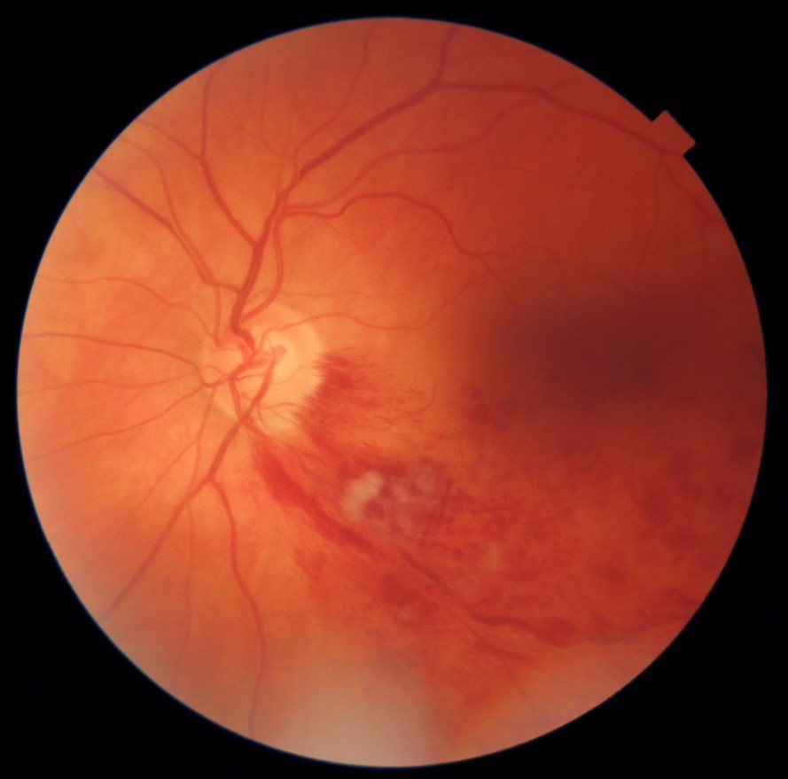 RetinaLyze case - Profil Optik Kalundborg - Venetrombose