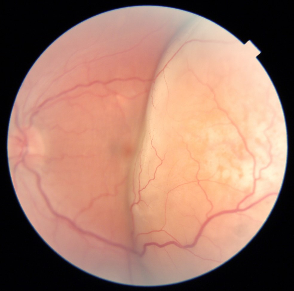 RetinaLyze case - Profil Optik Hadsund - Amotio Retina / nethindeløsning