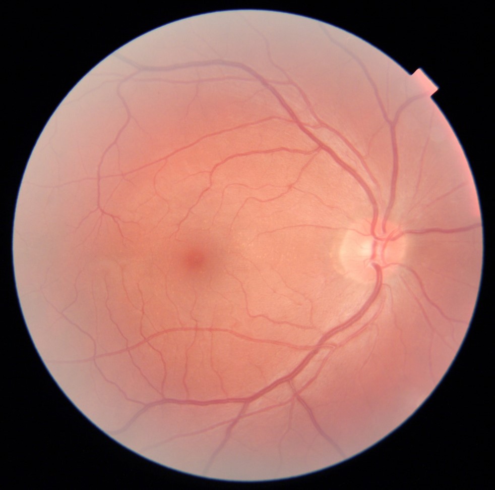 RetinaLyze case - Profil Optik Hadsund - Amotio Retina / nethindeløsning
