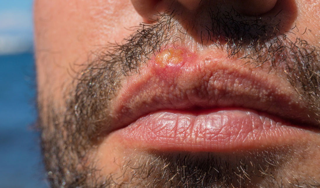 https://www.tiege.com/cdn/shop/articles/sunburn-lips-closeup.jpg?v=1569630986
