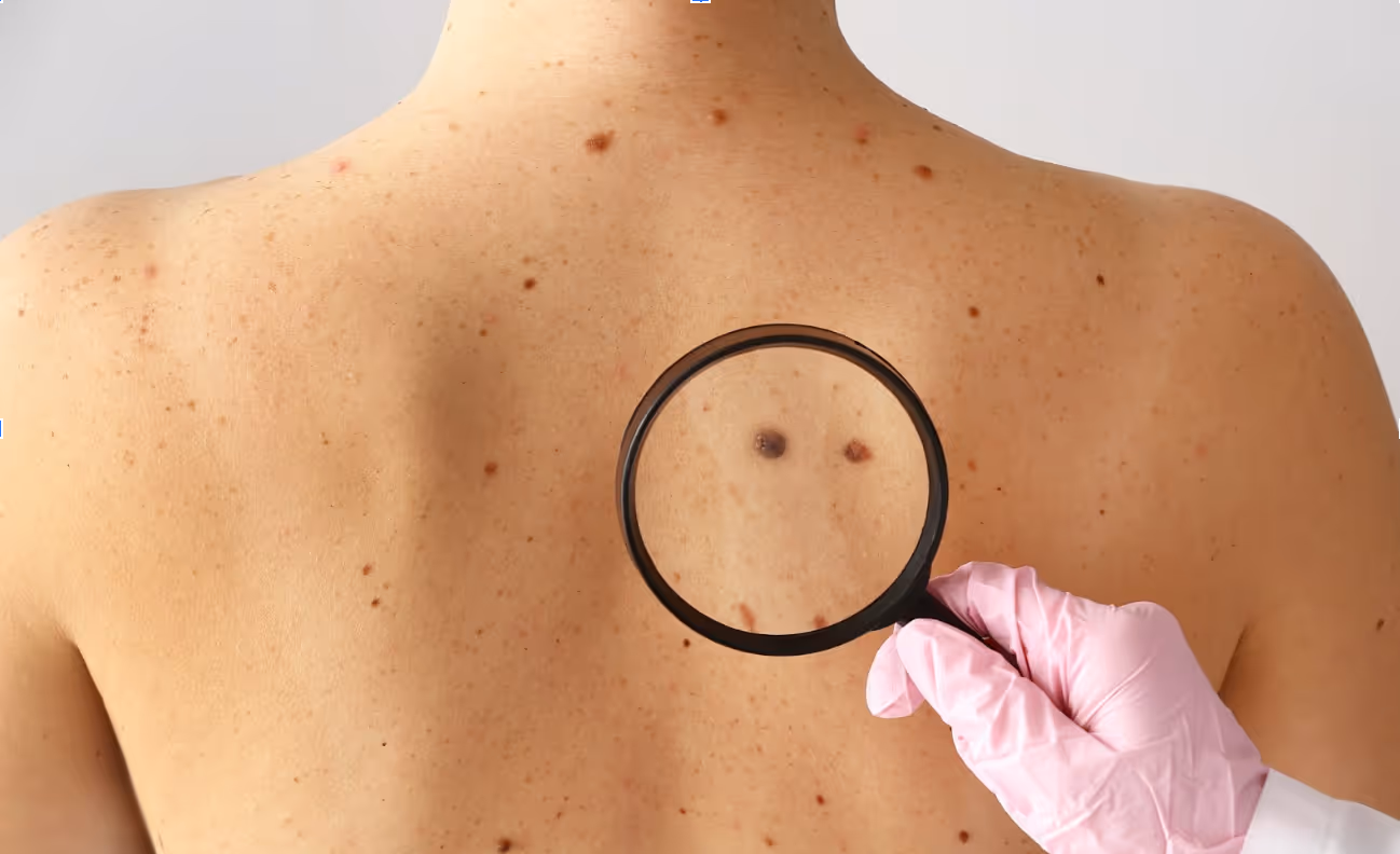 melanoma back