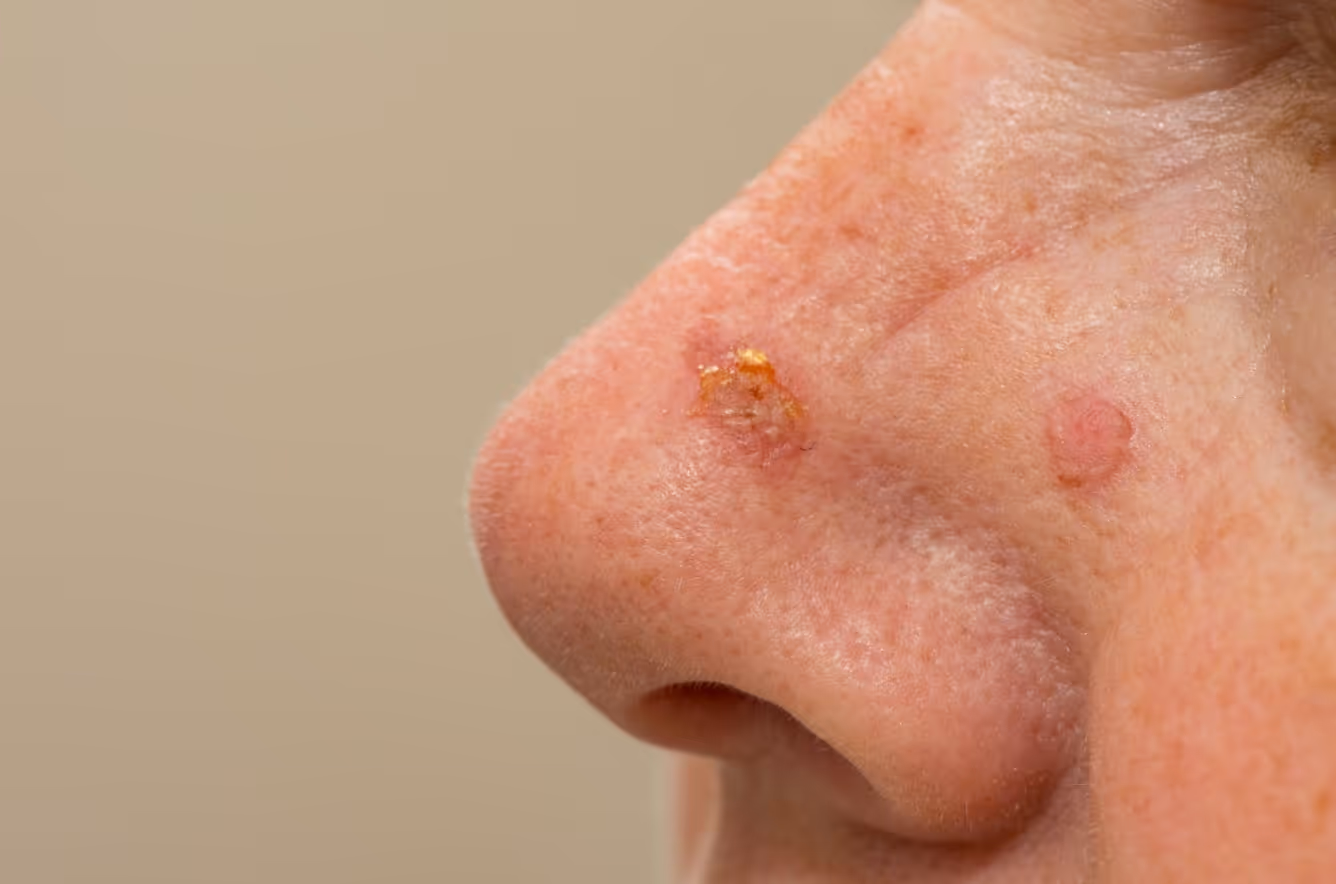 Actinic keratosis (precancerous lesions)