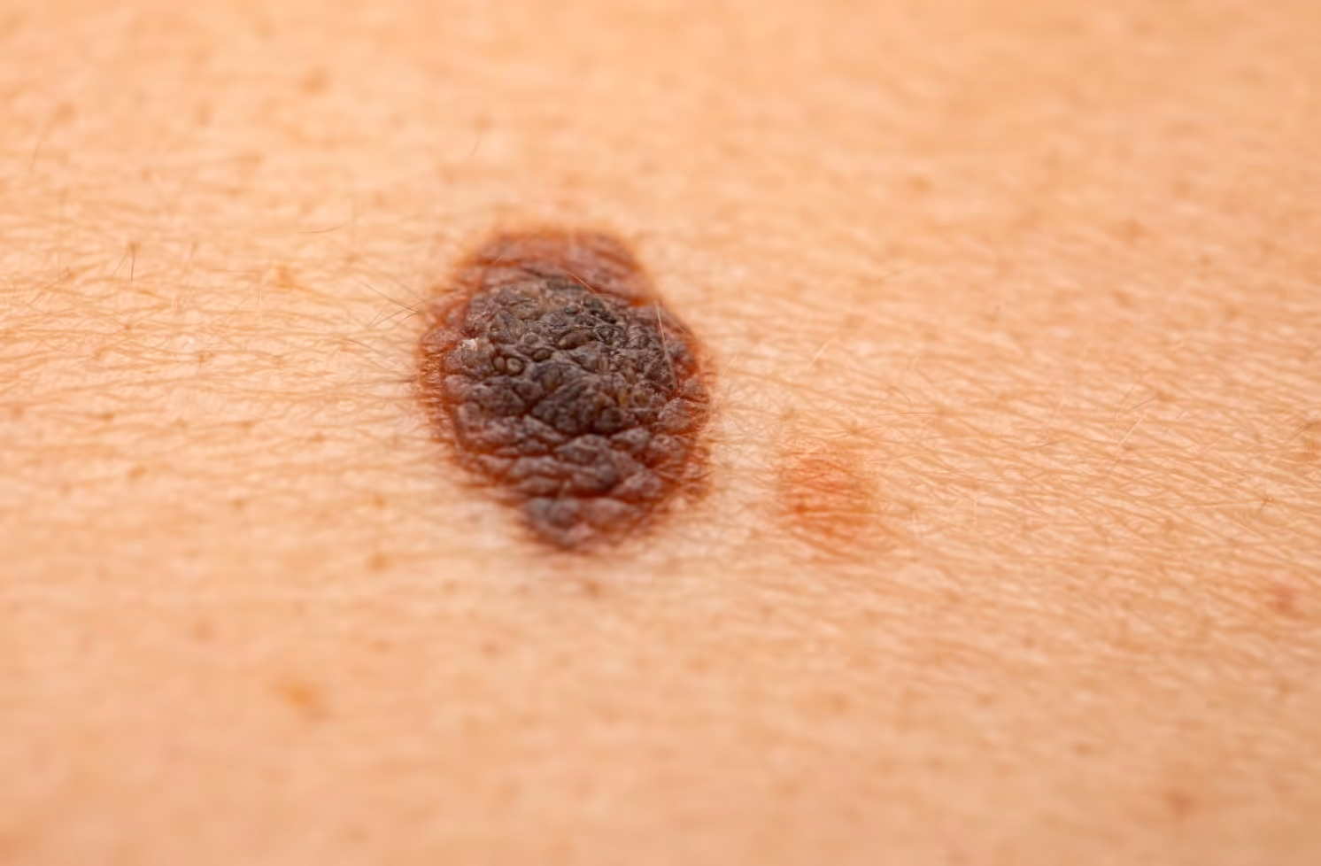 Melanoma