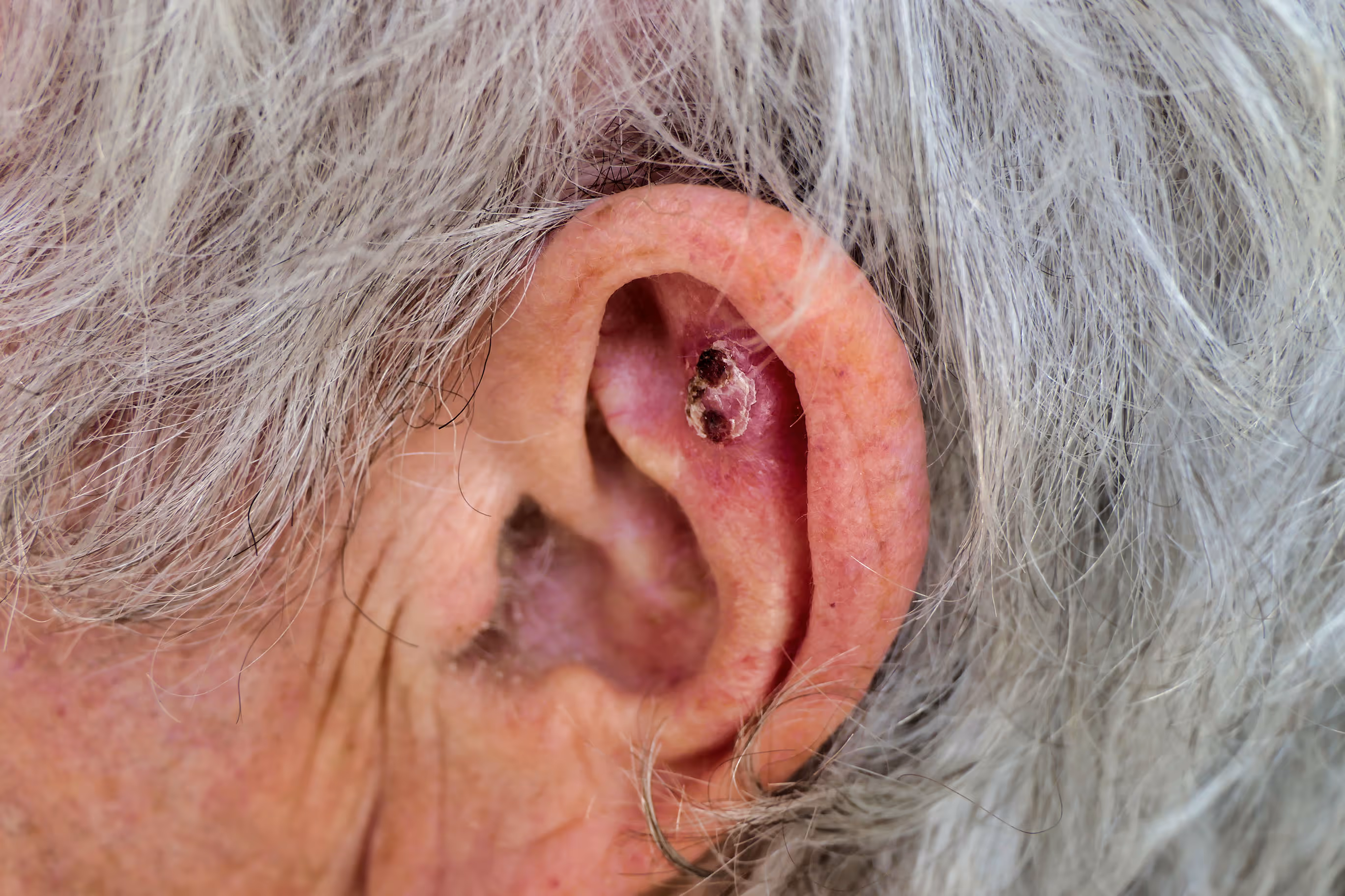 Squamous cell carcinoma (SCC)