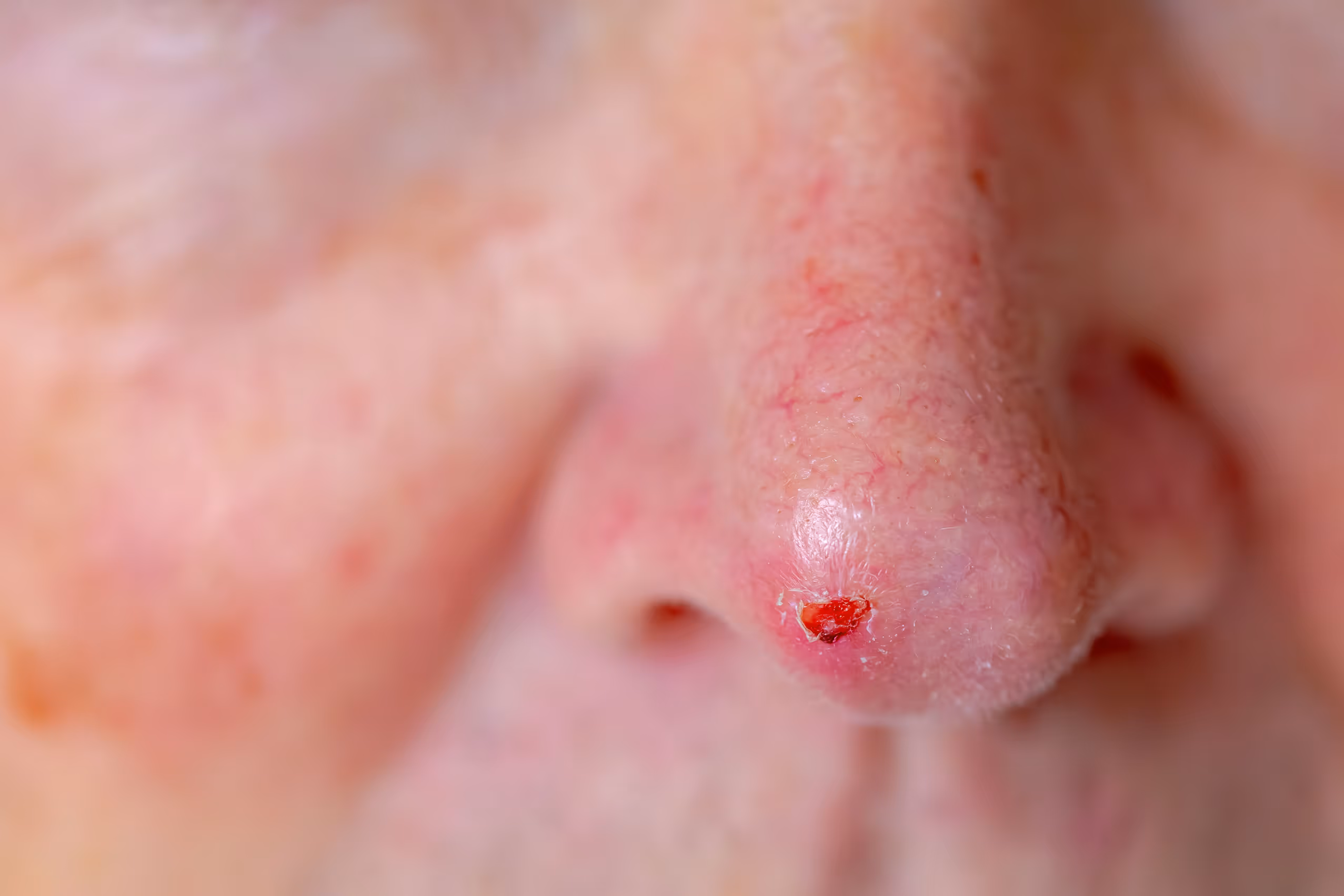 Basal cell carcinoma (BCC)