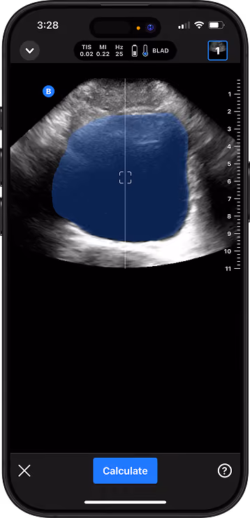 Handheld ultrasound app highlighting the bladder for automated volume calculation.