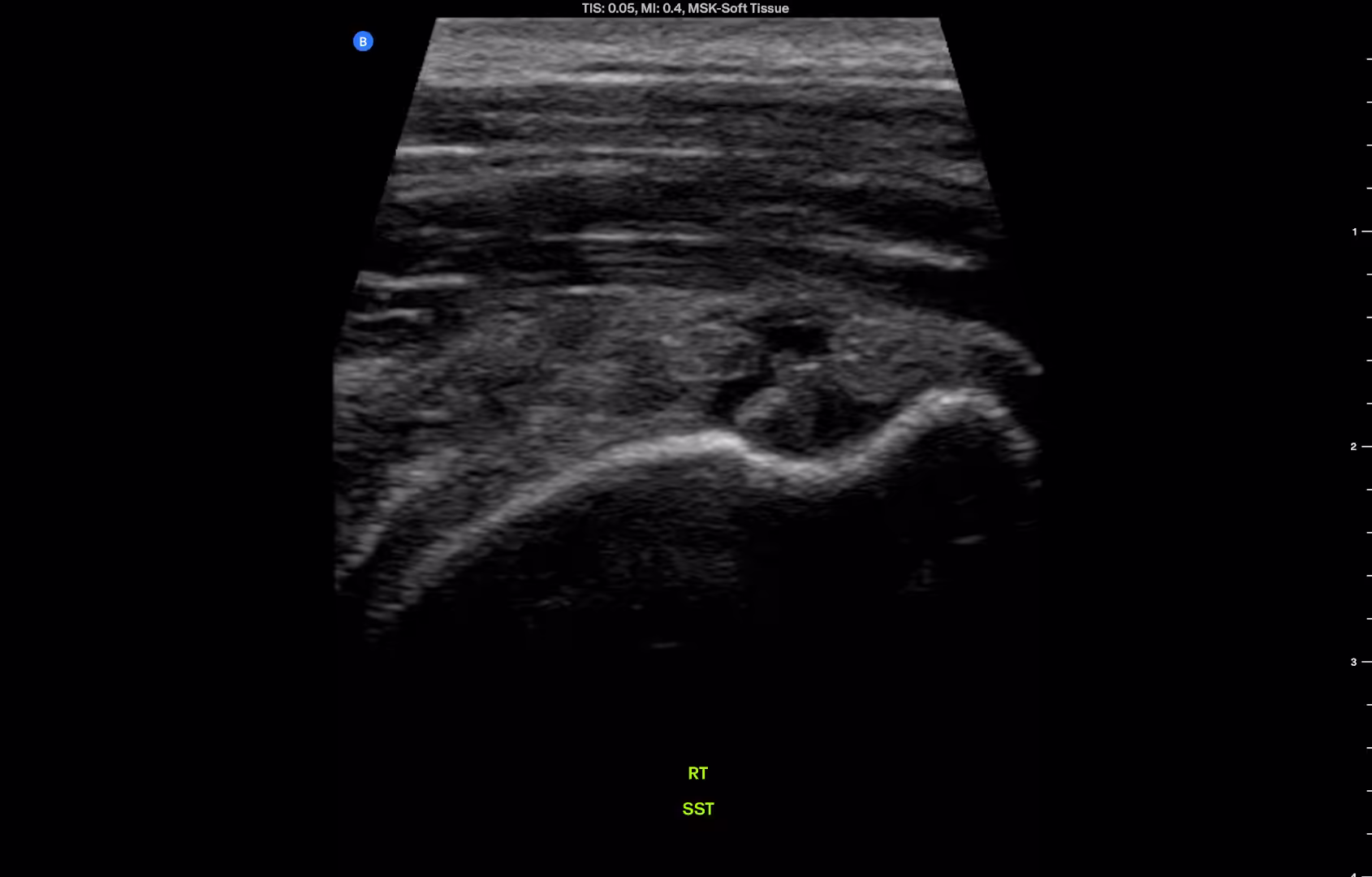 FIGURE 1.1 Right supraspinatus, long axis. Anechoic cleft through the tendon near its humeral attachment.