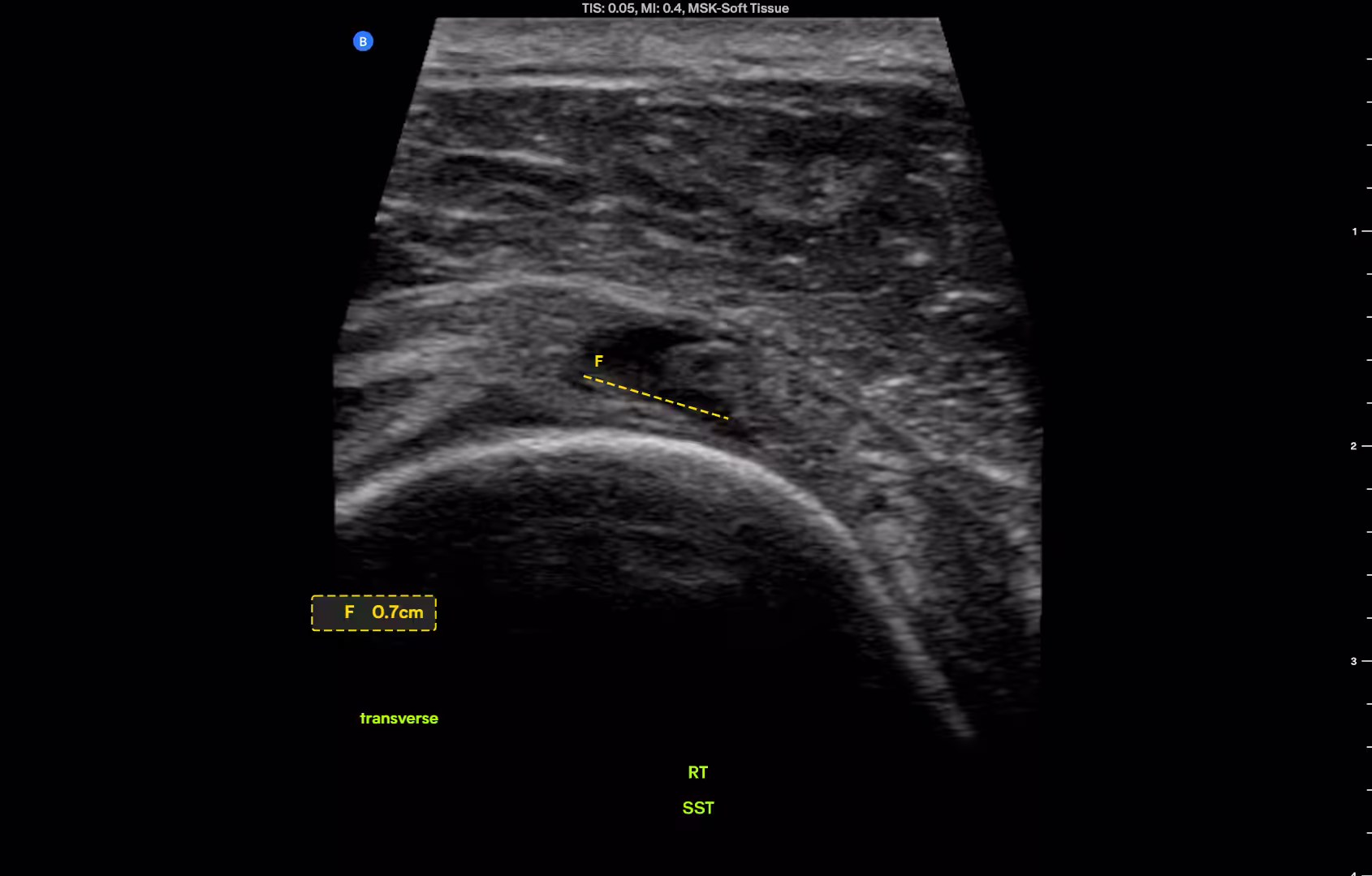 FIGURE 1.2 Same tendon, transverse. Full-thickness gap, superficial to deep; tear width 0.7 cm.