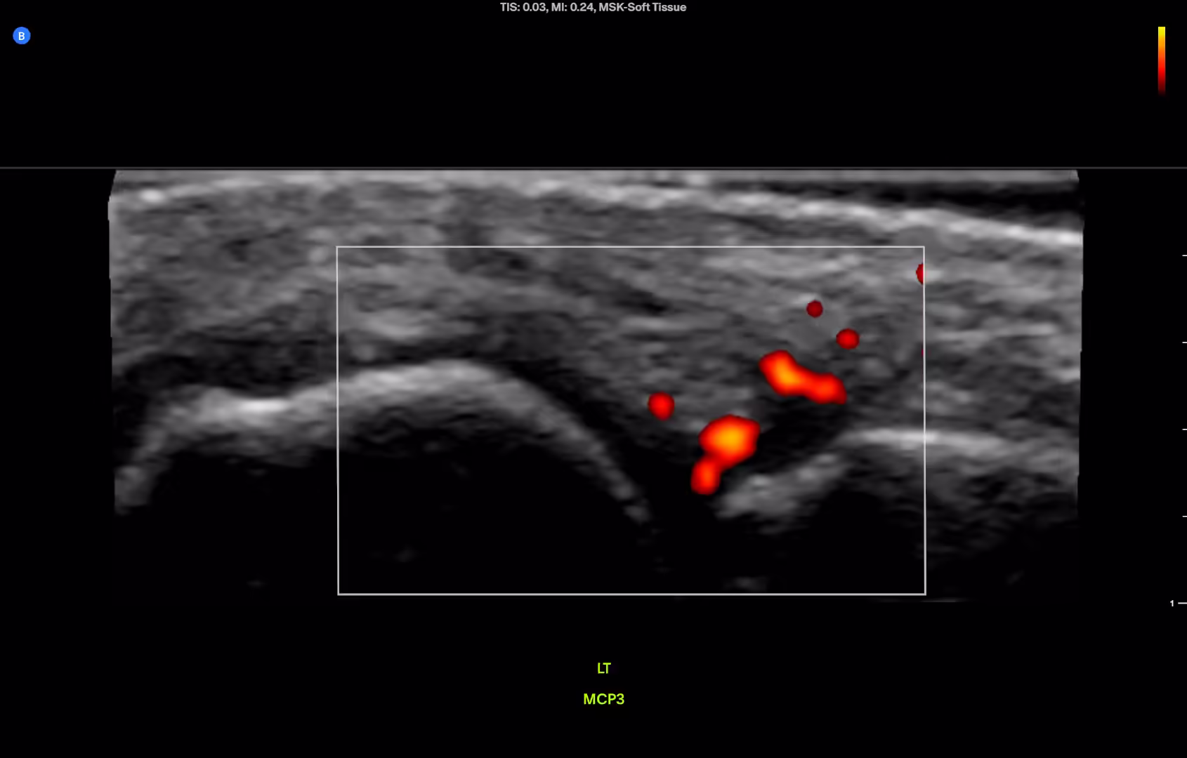 FIGURE 2.1 Left third MCP, longitudinal. Thickened hypoechoic synovium with pulsatile flow on power Doppler.