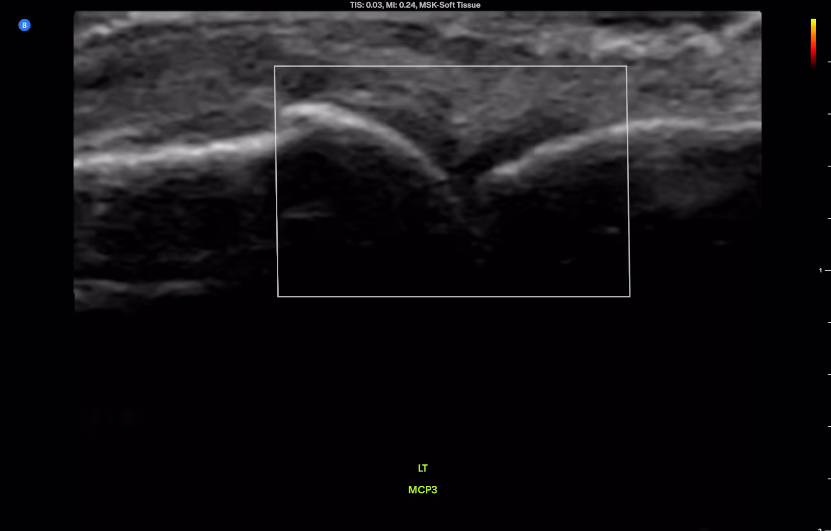 FIGURE 2.2 Same joint in a healthy patient shows a very thin anechoic rim of normal synovium and articular cartilage, and no flow in the power doppler box.