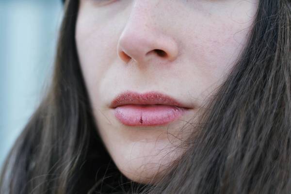 Close-Up Of Rough Lips
