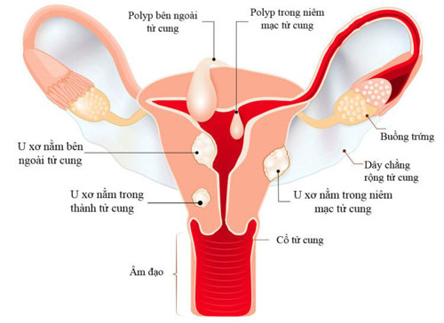 bệnh u xơ tử cung là gì