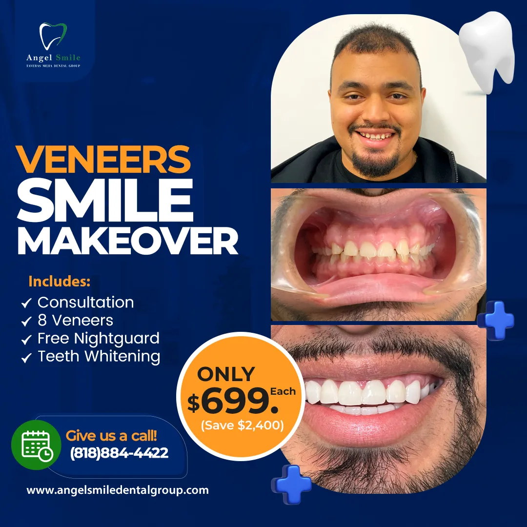 Porcelain veneers results at Angel Smile Dental Group, Chatsworth