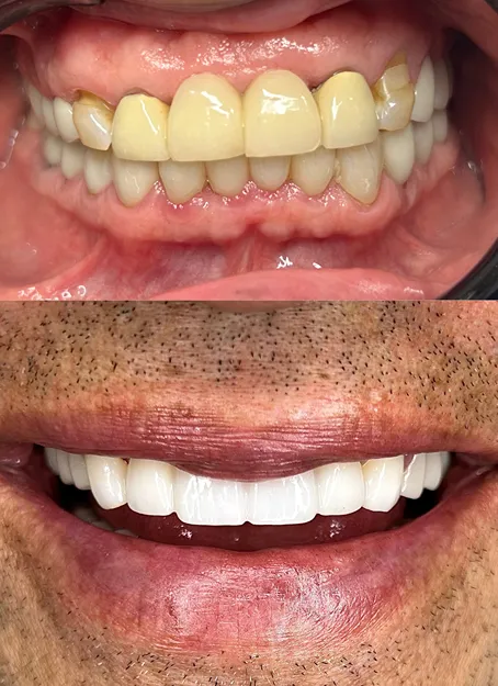 Dental bridge result at Angel Smile Dental Group in Chatsworth, CA