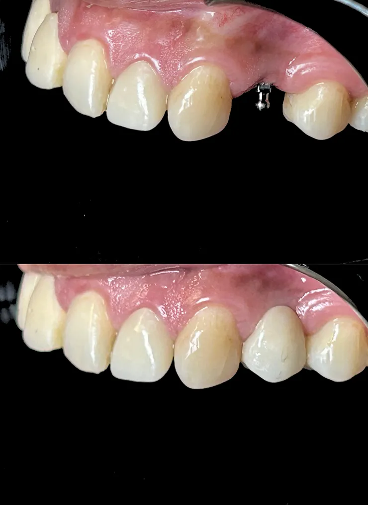 Mini dental implants smile design at Angel Smile Dental Group, Chatsworth