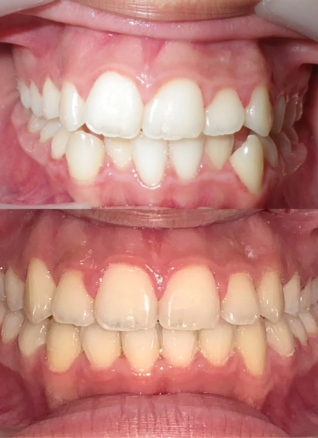 Orthodontic braces treatment at Angel Smile Dental Group, Chatsworth