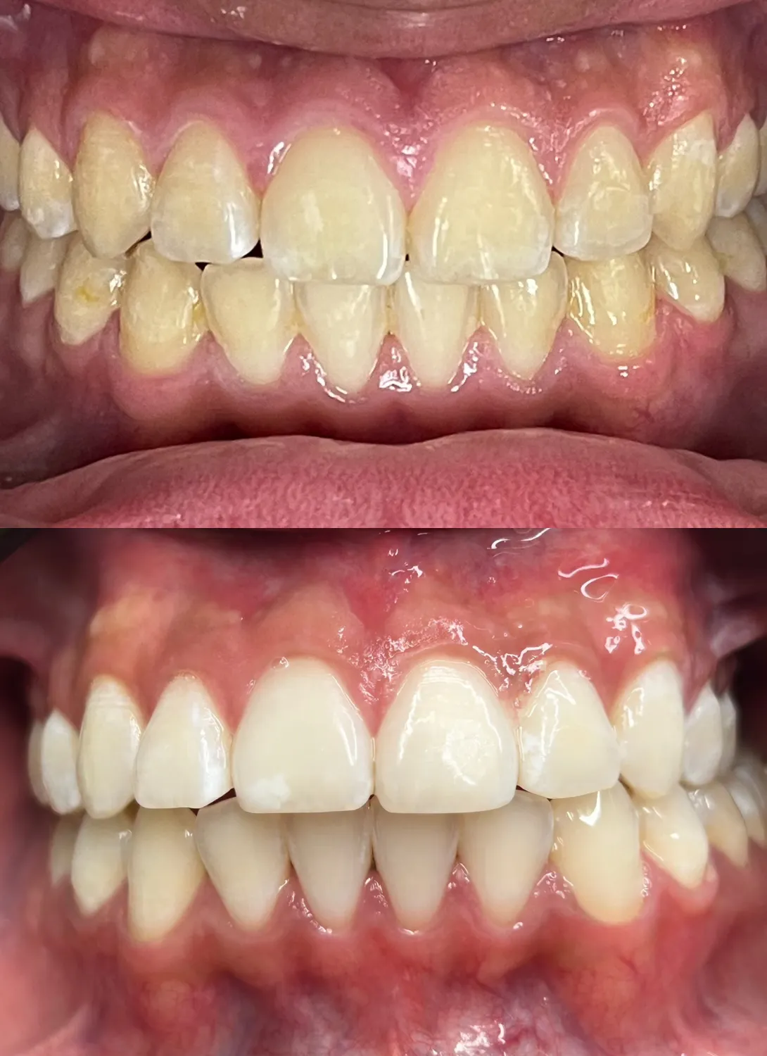Teeth whitening at Angel Smile Dental Group, Chatsworth dentist
