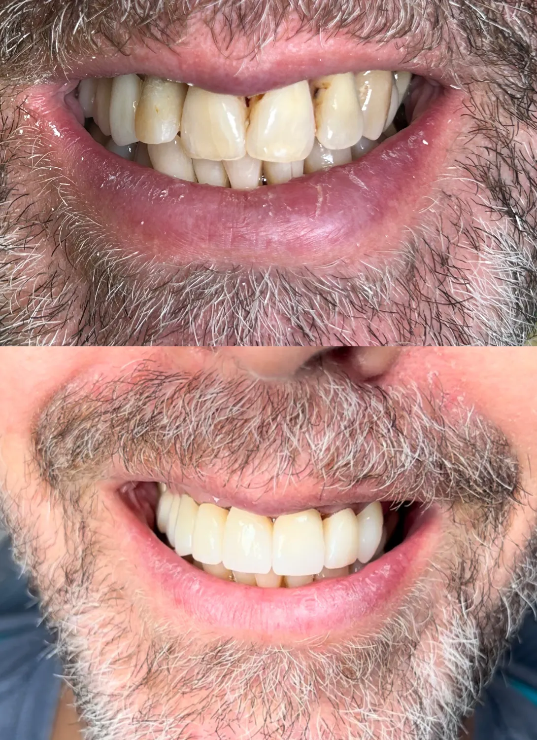 Dental crown treatment at Angel Smile Dental Group, Chatsworth CA