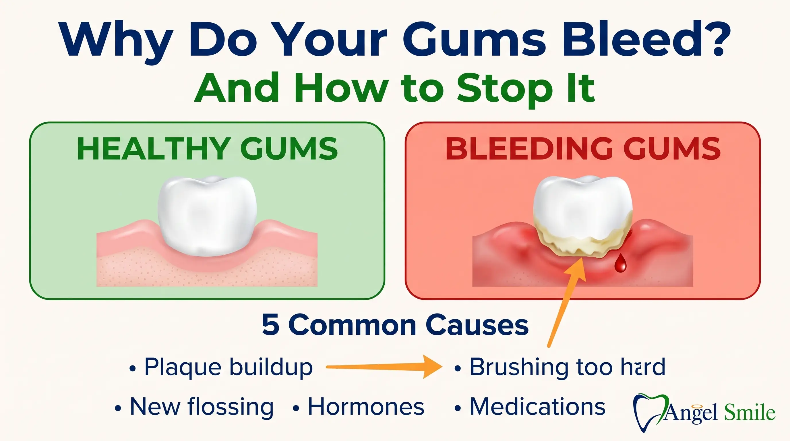 Why Do My Gums Bleed When I Brush? The Real Reasons - Angel Smile Dental Group