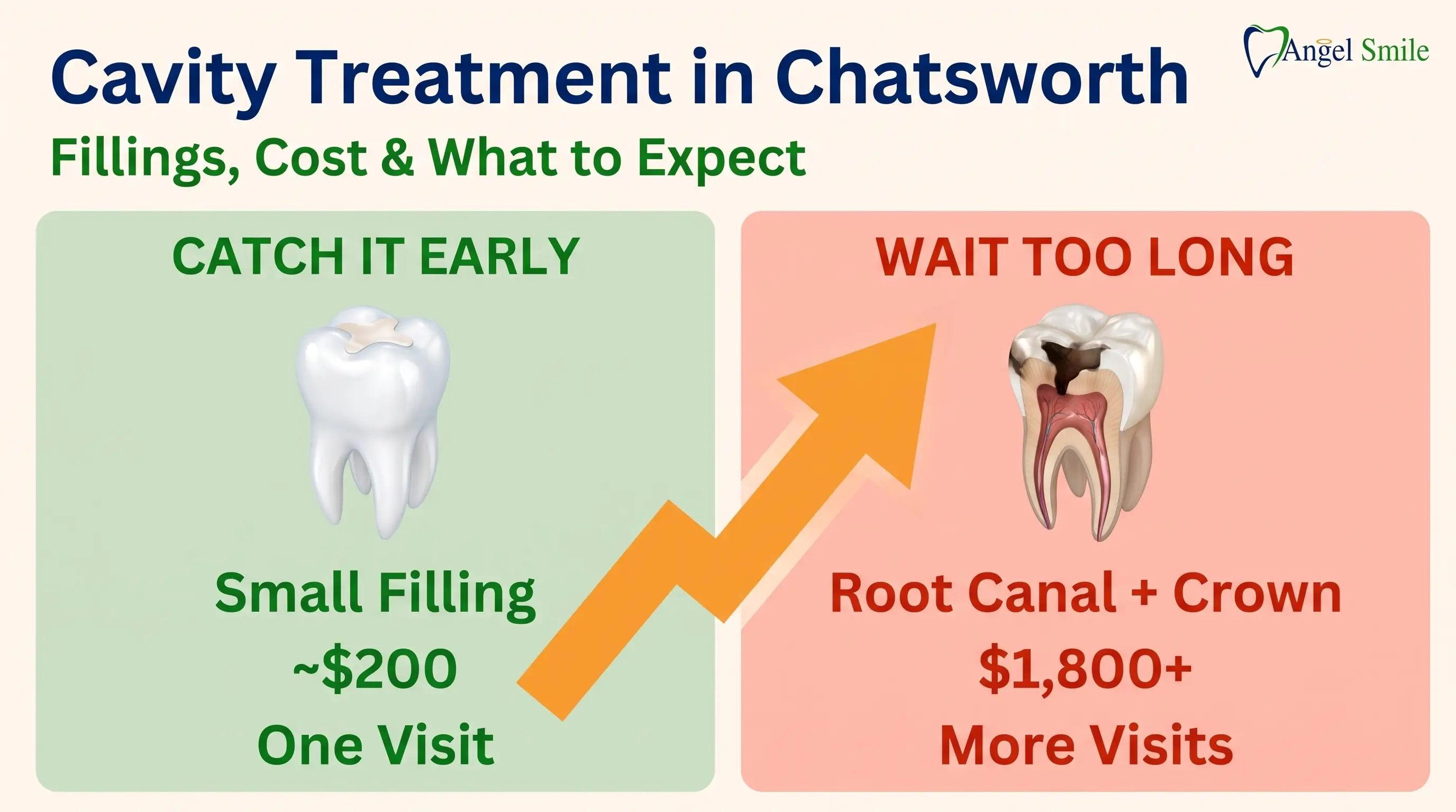 Cavity Treatment in Chatsworth: Fillings, Cost, and What to Expect — Angel Smile Dental Group