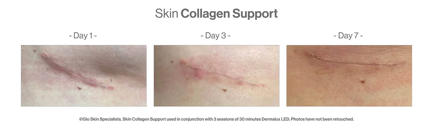 SKIN COLLAGEN SUPPORT, Deze slimme cocktail van vitamine C, zink, MSM, druivenpitextract en meloenconcentraat wordt ondersteund door meer dan 150 studies over de doeltreffende werking van de ingrediënten op de huid.