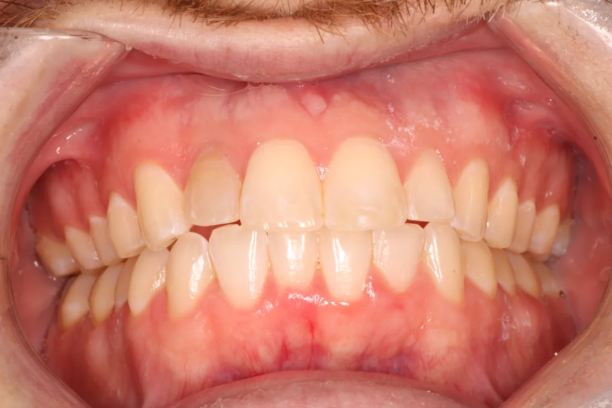 Teeth after Invisalign treatment, case 4