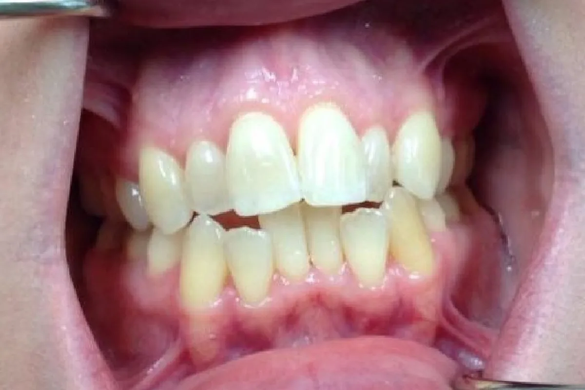 Teeth before Invisalign treatment, case 3