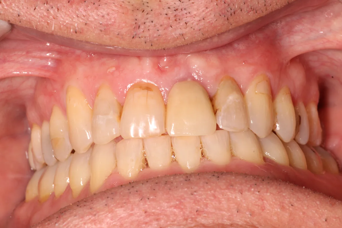 Teeth after Invisalign treatment, case 5