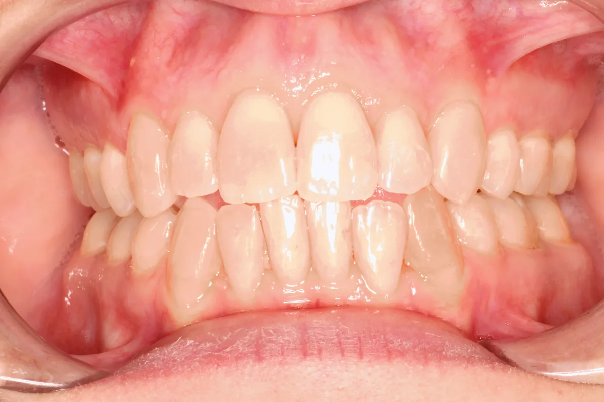 Teeth after Invisalign treatment, case 3