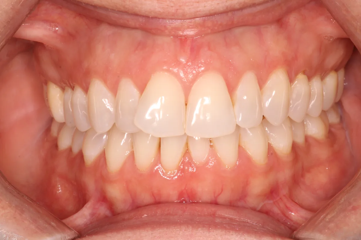 Teeth before Invisalign treatment, case 6