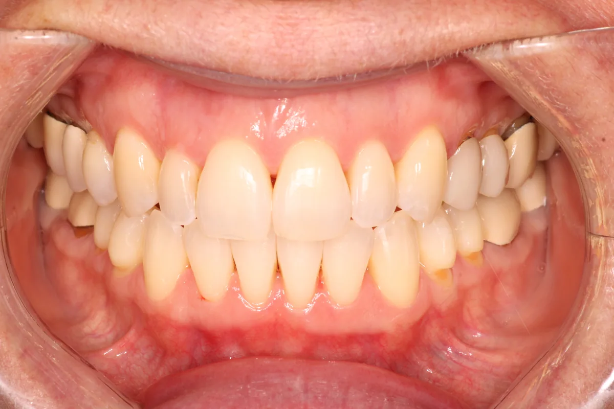 Teeth after Invisalign treatment, case 1