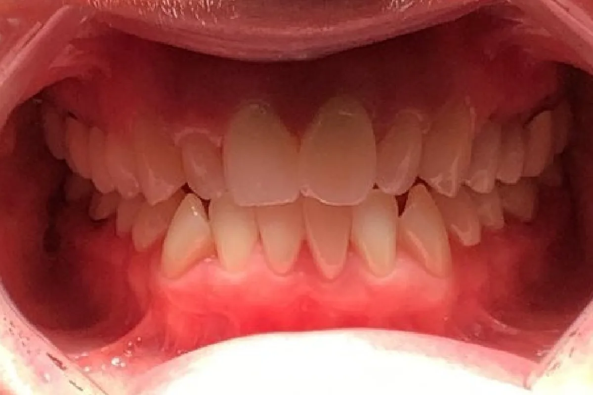 Teeth before Invisalign treatment, case 1