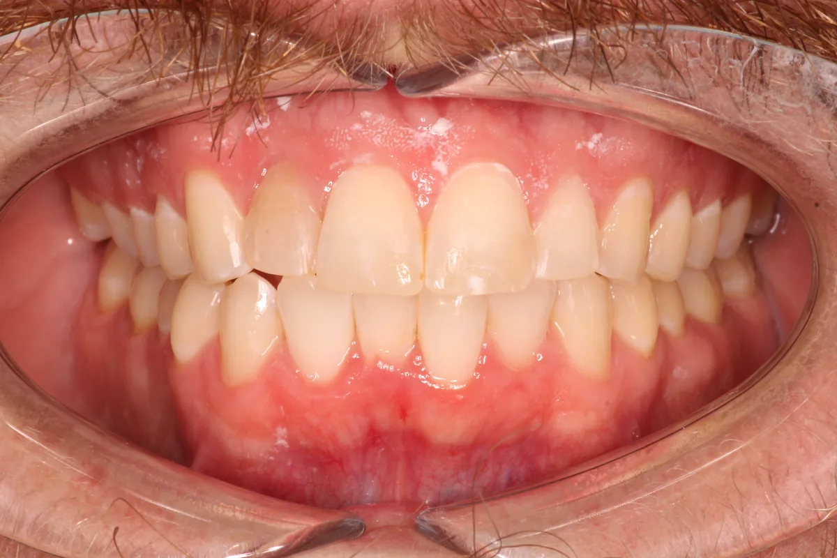 Teeth before Invisalign treatment, case 4