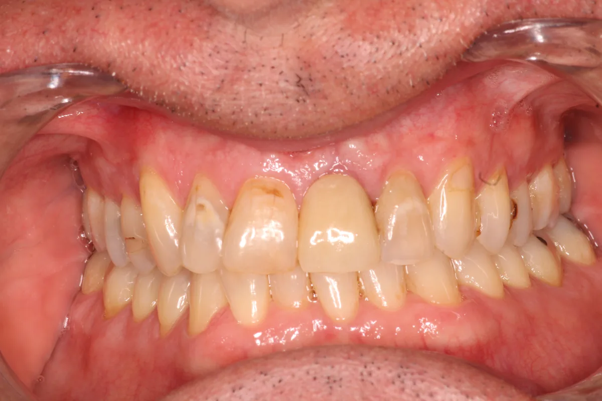 Teeth before Invisalign treatment, case 5
