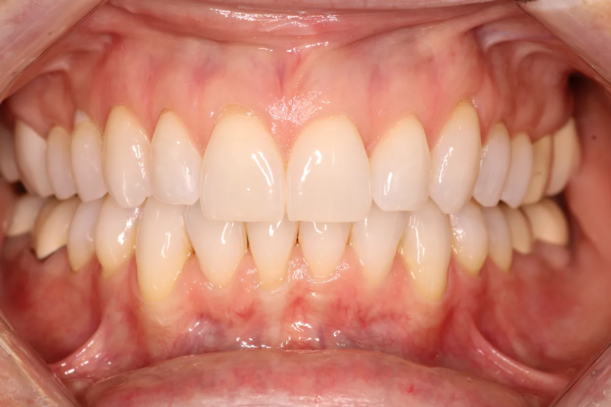 Teeth after Invisalign treatment, case 2