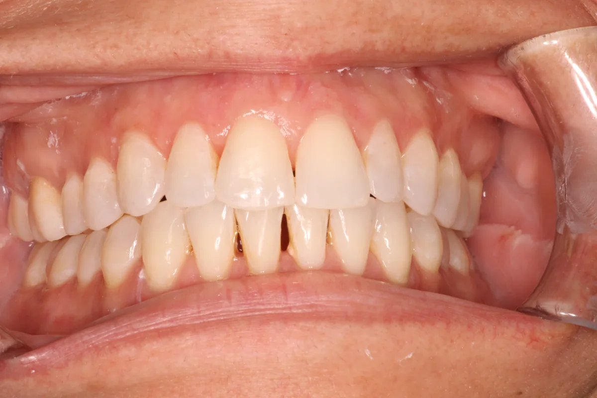 Teeth after Invisalign treatment, case 6